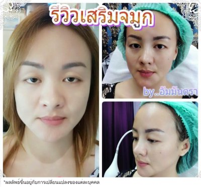 รูปผลการทำศัลยกรรมจมูก
